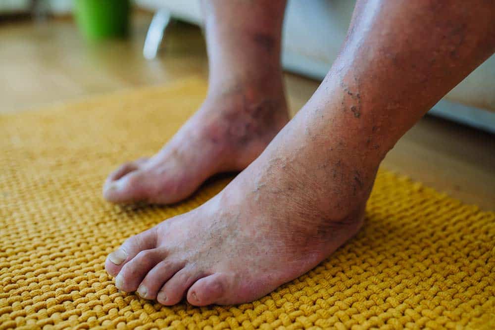 Edema feet